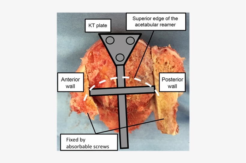 Jet Type Helmet Like Allograft That We Created - Kerboull Plate, transparent png download