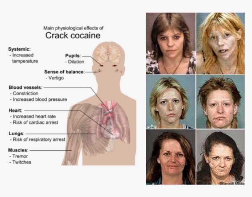 Learn About The Immediate Shortterm And Longterm Cocaine - Crack Does To Your Body, transparent png download