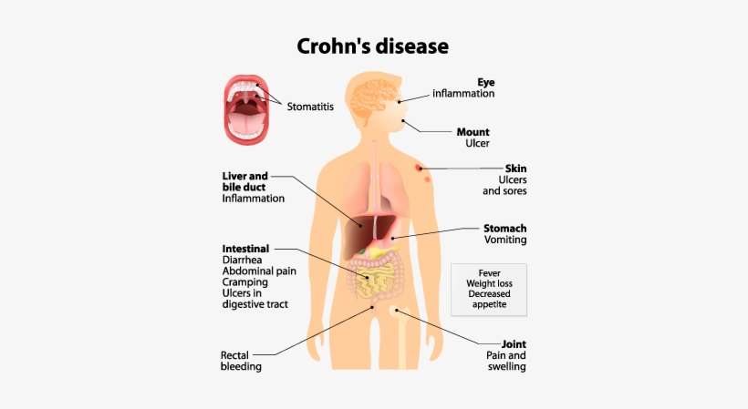 Why Is Capsule Endoscopy Done - Dont Text And Drive, transparent png download