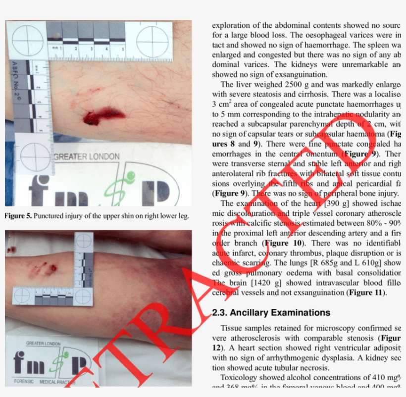 Punctured Injury Of The Lower Calf On Right Lower Leg, - Blood, transparent png download