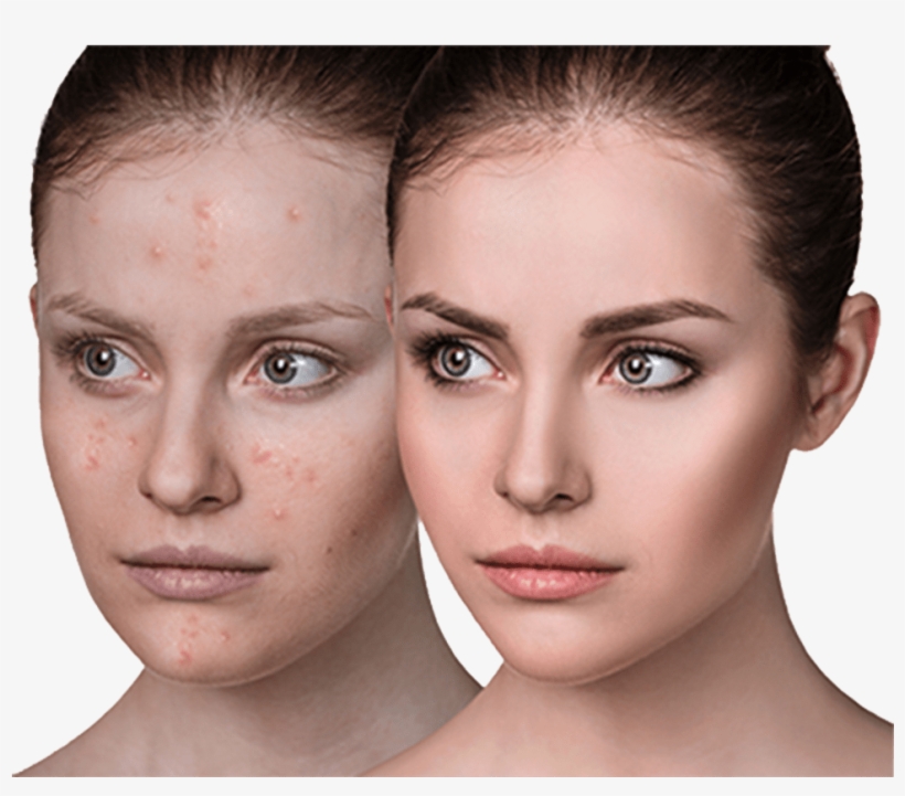 Acne Vulgaris Treatment - Mangosteen Skin Benefits For Cancer, transparent png download