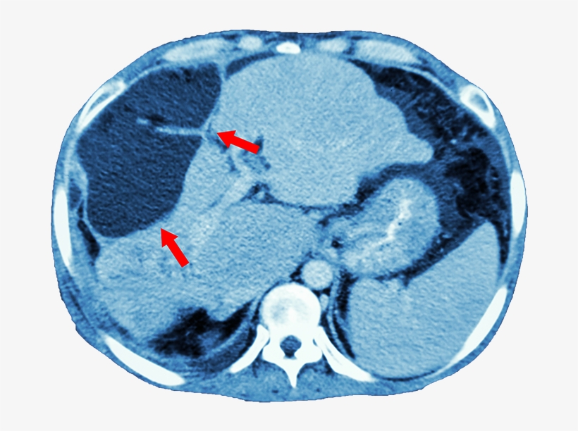 Of The Abdomen And Pelvis) To Look For A Mass In The - Ct Scan Dataset Of Liver Cancer, transparent png download