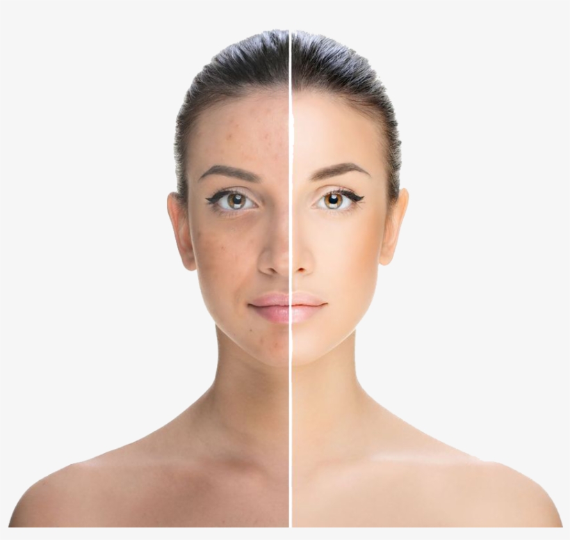 Hsmodelface - Chemical Peel, transparent png download