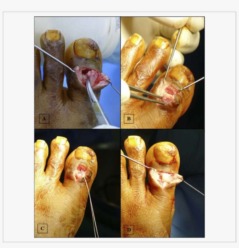 Dorsal T-shaped Incision With The Ip Joint Explored - Twinkie, transparent png download