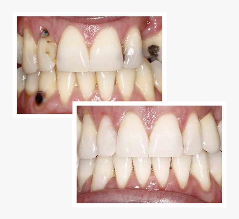 Before And After Full Mouth Reconstruction - Laugh, transparent png download