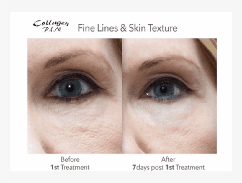 Before And After - Microneedling Fine Lines Before And After, transparent png download