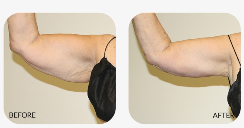 This Surgical Procedure Reduces Sagging Excess Skin - Upper Arms, transparent png download