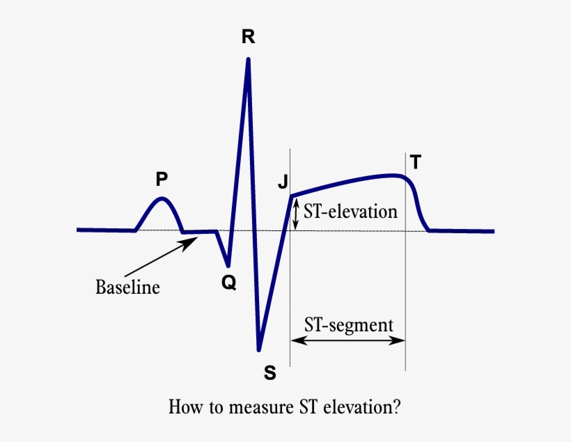 Stelevatie En - Ecg Of Mi Patient, transparent png download