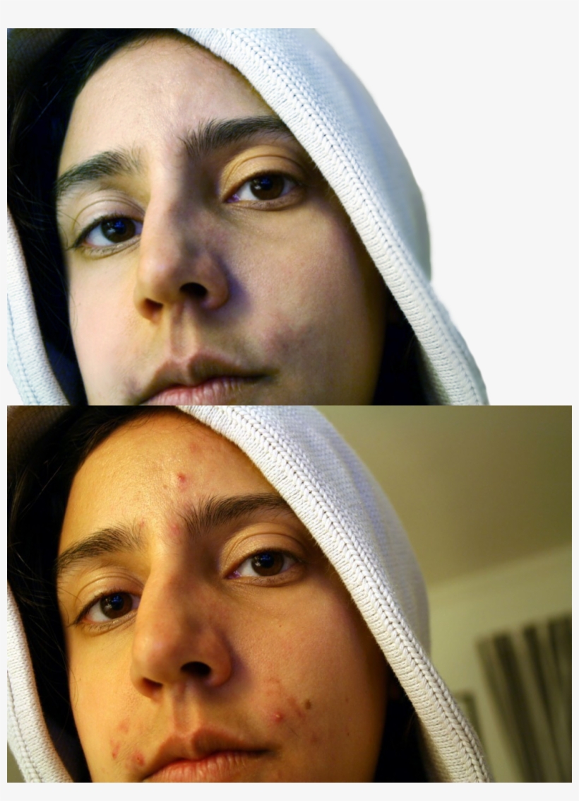I Will Remove Acne From Your Face - Light Skin With Pimples, transparent png download