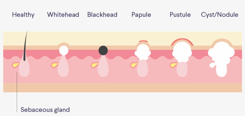 What Is Acne, Anyway First Off, Knowledge Is Power - Diagram, transparent png download