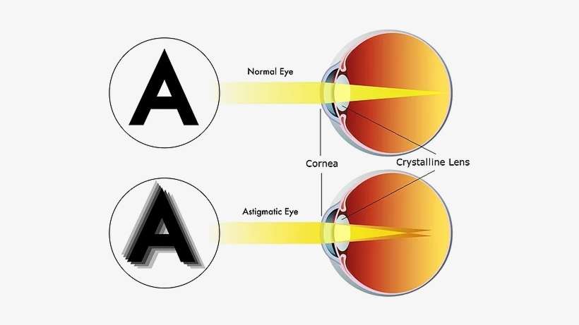 Astigmatism - Normal Eye Vs Astigmatism, transparent png download