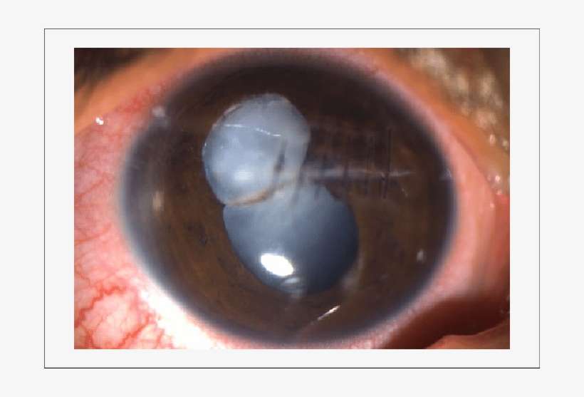 Slit Lamp Photograph Showing Ruptured Anterior Lens - Art, transparent png download