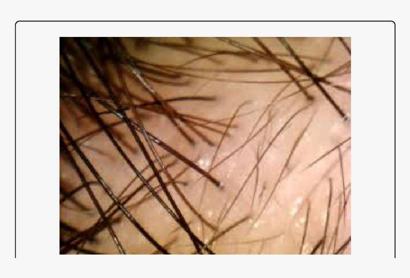 Thin Slow Growing Hair Over Affected Area With Adjacent - Macro Photography, transparent png download