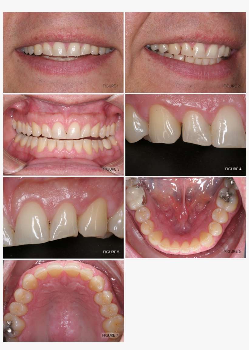 Figures 1 7 Copy - Tooth Bleaching, transparent png download