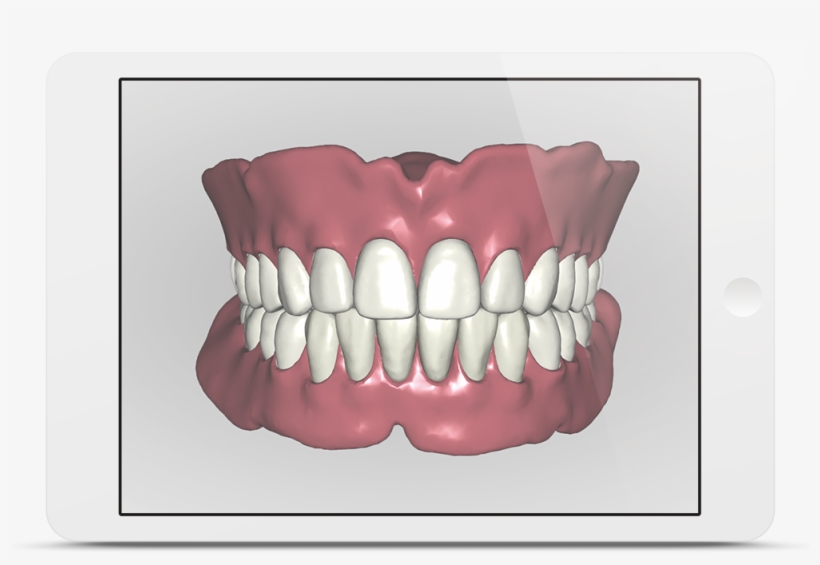 Avadent Ipad - 3d Gebitsprothese, transparent png download