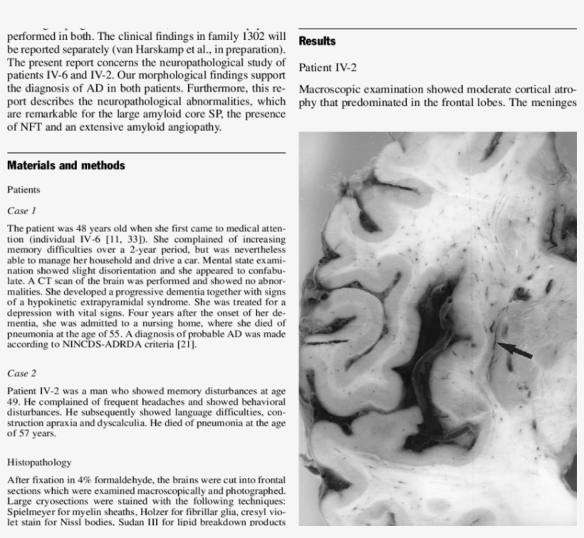 Small Subcortical Hemorrhage In The Right Insular Region - Monochrome, transparent png download