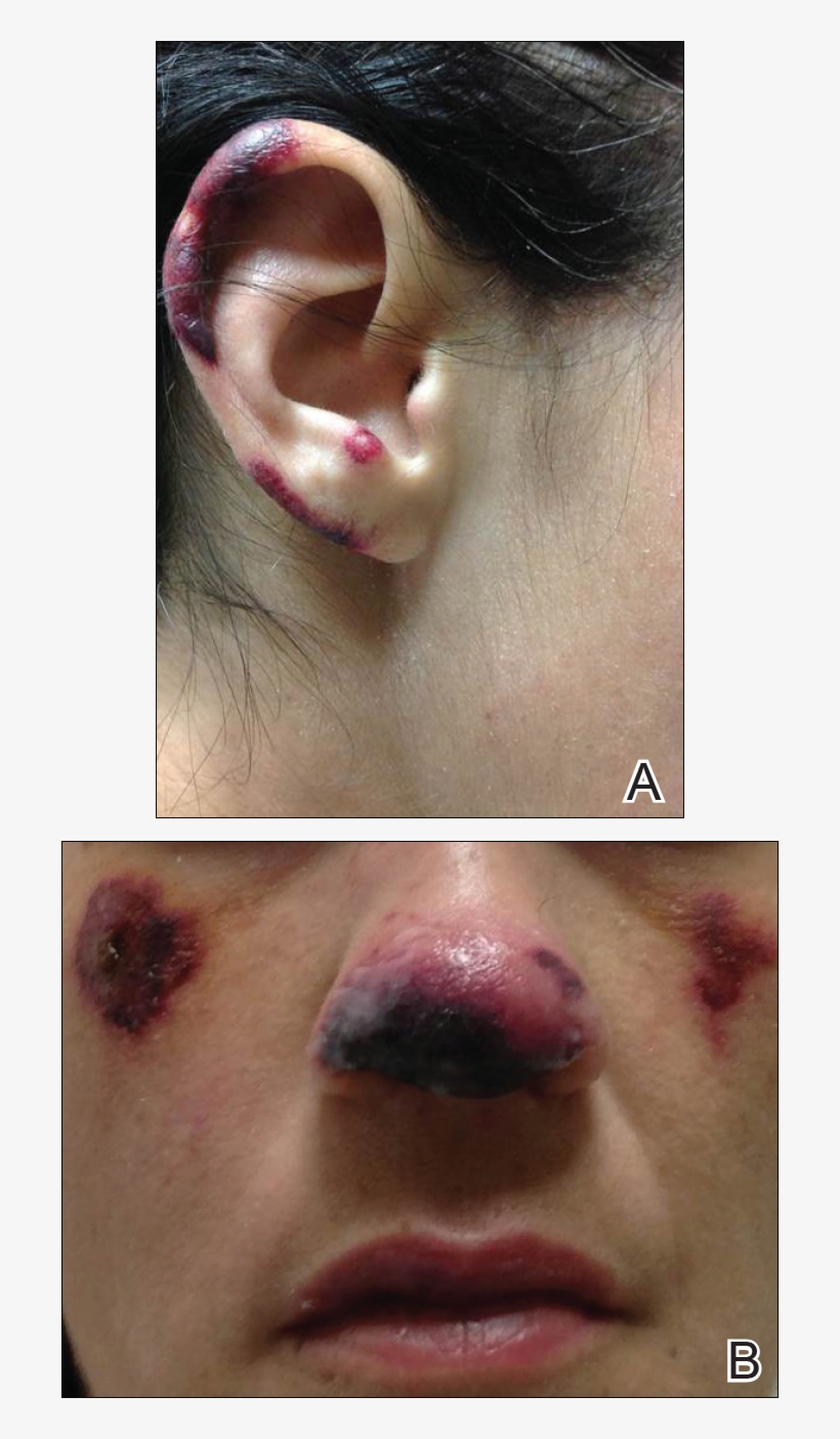 Purpura And Hemorrhagic Bullae Of The Right Ear As - Body Jewelry, transparent png download