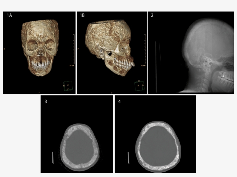 This Is A Frontal 3d Reconstruction View Showing Multiple - Maxillofacial Ct Scan, transparent png download