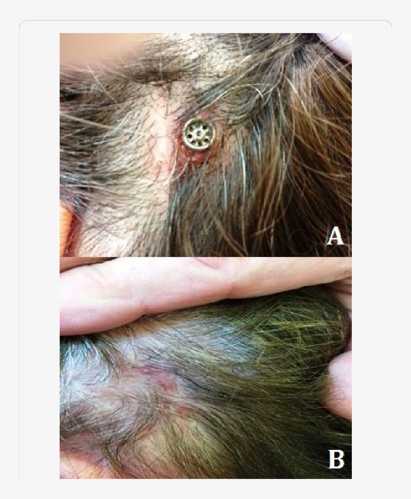 Case 1 Peri-implant Infection, 3 Months After Installation - Peri Implant Infection, transparent png download