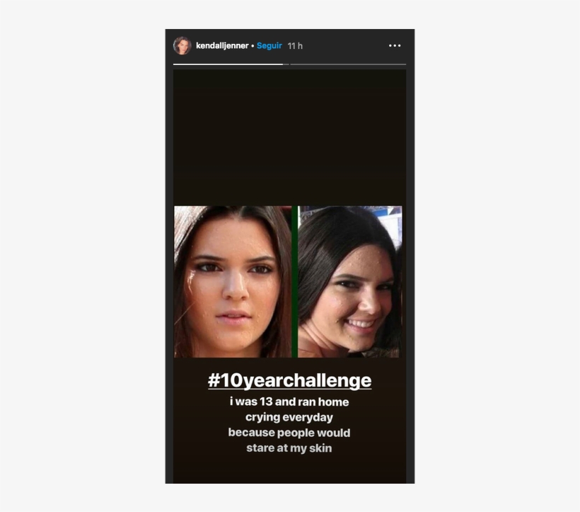 Kendall Jenner Se Une Al - Kendall Jenner Acne, transparent png download