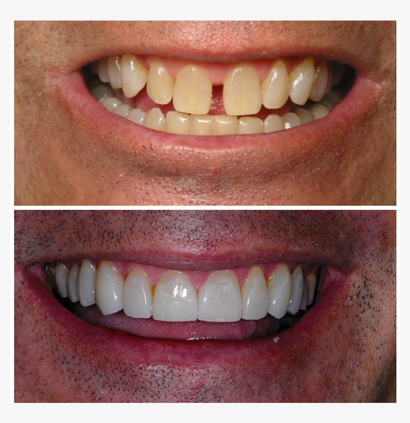 Closed-png - Cosmetic Dentistry, transparent png download