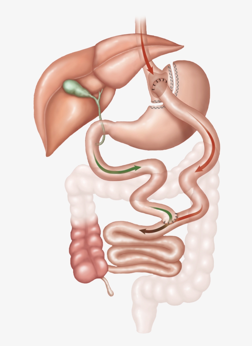 Gastric Bypass Surgery - Roux En Y Gastric Bypass, transparent png download