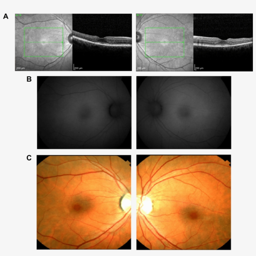 Bull's Eye Maculopathy Visible On Near-infrared Reflectance - Medical Imaging, transparent png download