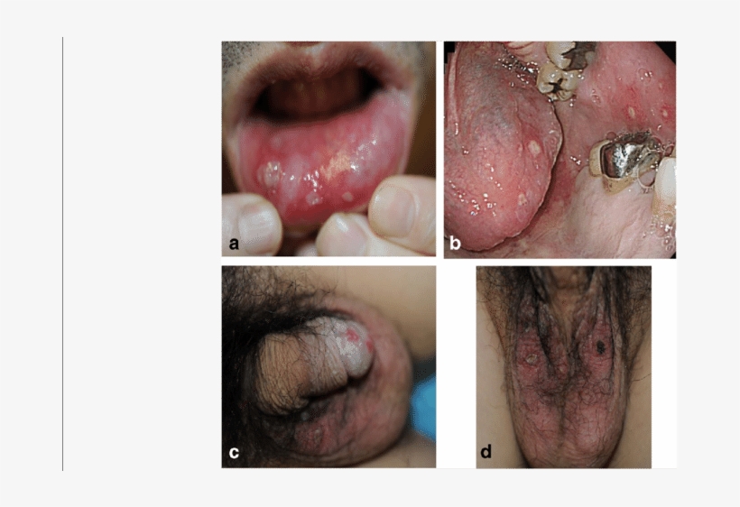 A Ulcers On The Lower Lip - Tongue, transparent png download