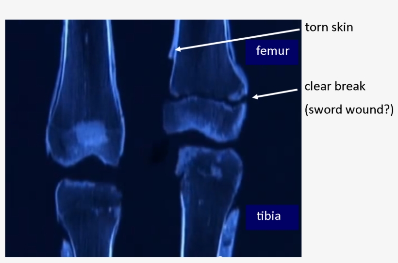 Tut's Leg Bones - King Tut Broken Femur, transparent png download