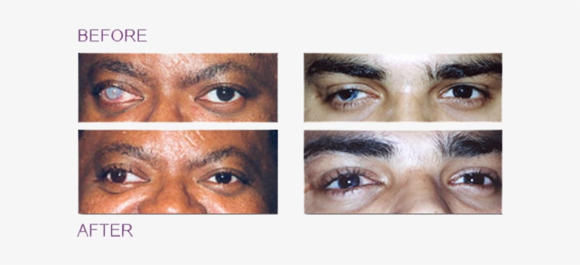 Corneal Tattoos - Tattoo, transparent png download