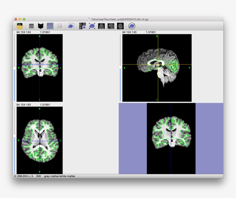 Click On The Image To The Right For A Larger View - B1 Bias Field Correction, transparent png download