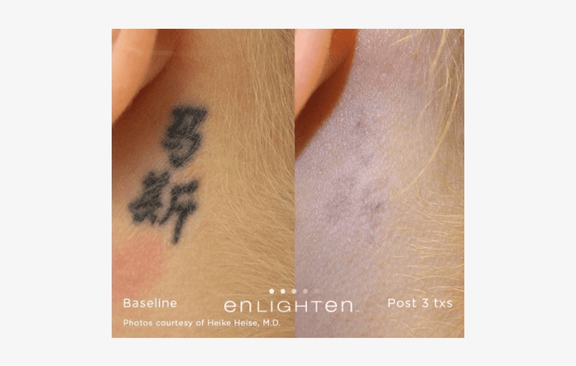 Tattoo Removal* - Tattoo, transparent png download