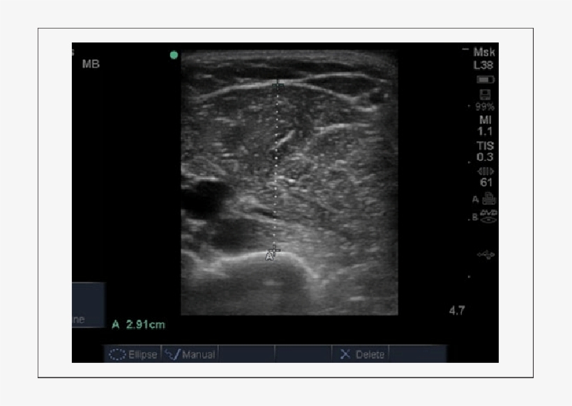 Ultrasound Image Of Mid Upper Arm Muscle Thickness - Muscles Upper Arm Ultrasound, transparent png download