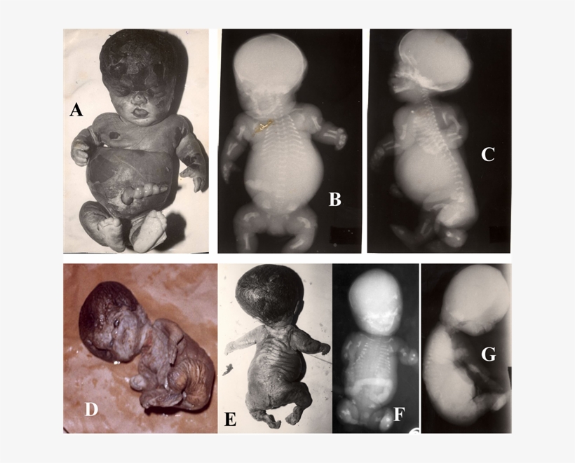 (r) Showing Lethal Skeletal Dysplasia - Byron Baxter Osteogenesis Imperfecta, transparent png download