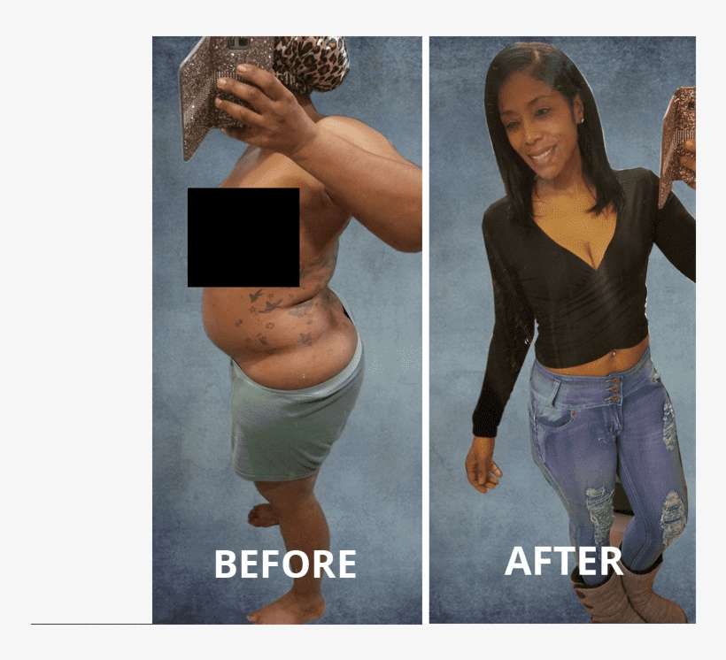 Beyond The Benefits Of Losing Weight, Orbera™ Is A - Temporary Gastric Balloon Before And After, transparent png download