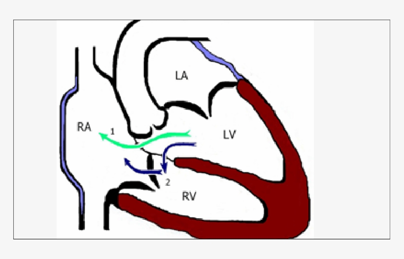 Defect Number One Is The Supravalvular (direct) Type,, transparent png download