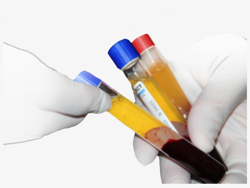 What Part Of The Face Can Prp Treat - Blood Plasma, transparent png download