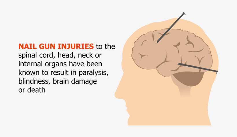Nail Gun Injuries To The Spinal Cord, Head, Neck Or - Injury, transparent png download