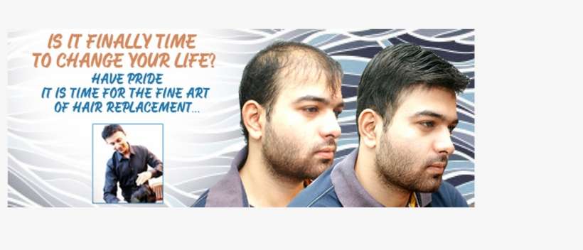 Your New Unit Will Be Shaped And Sized To Match Your - Hair Replacement For Men In Kuala Lumpur, transparent png download