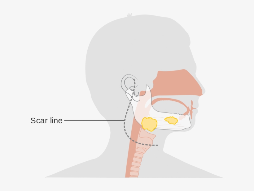 It Is The Most Common Cause That Results In It In The - Illustration, transparent png download