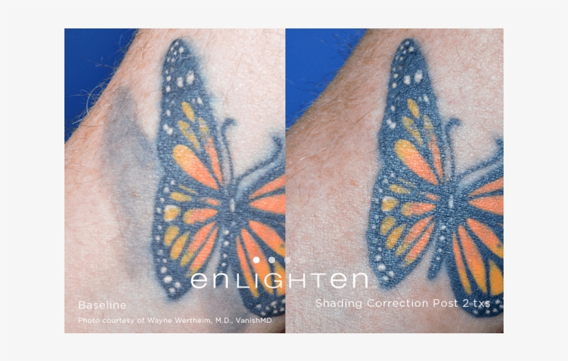 Tattoo Removal* - Tattoo, transparent png download