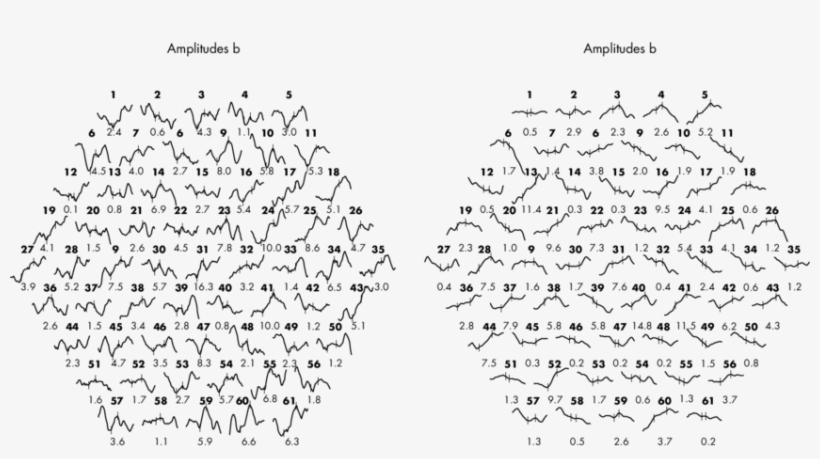 Preoperative Multifocal Electroretinogram Of Case 1 - Handwriting, transparent png download