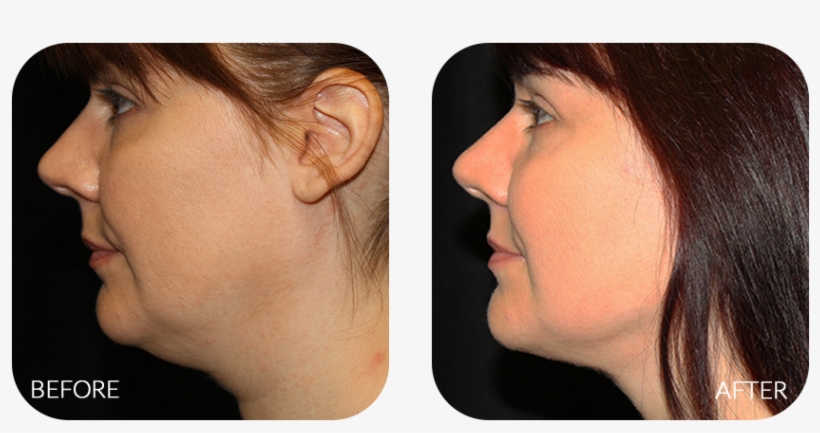 While Diet And Exercise Are Effective In Combating - Chin Filler And Liposuction, transparent png download