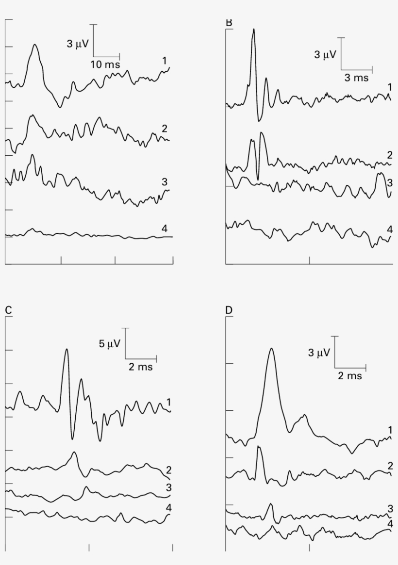 Sample Of Various Ep Waveforms Under Diverent Spinal - Diagram, transparent png download