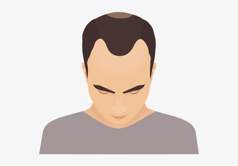 In Phase 2 Of Male Pattern Baldness We Start To Notice - Illustration, transparent png download