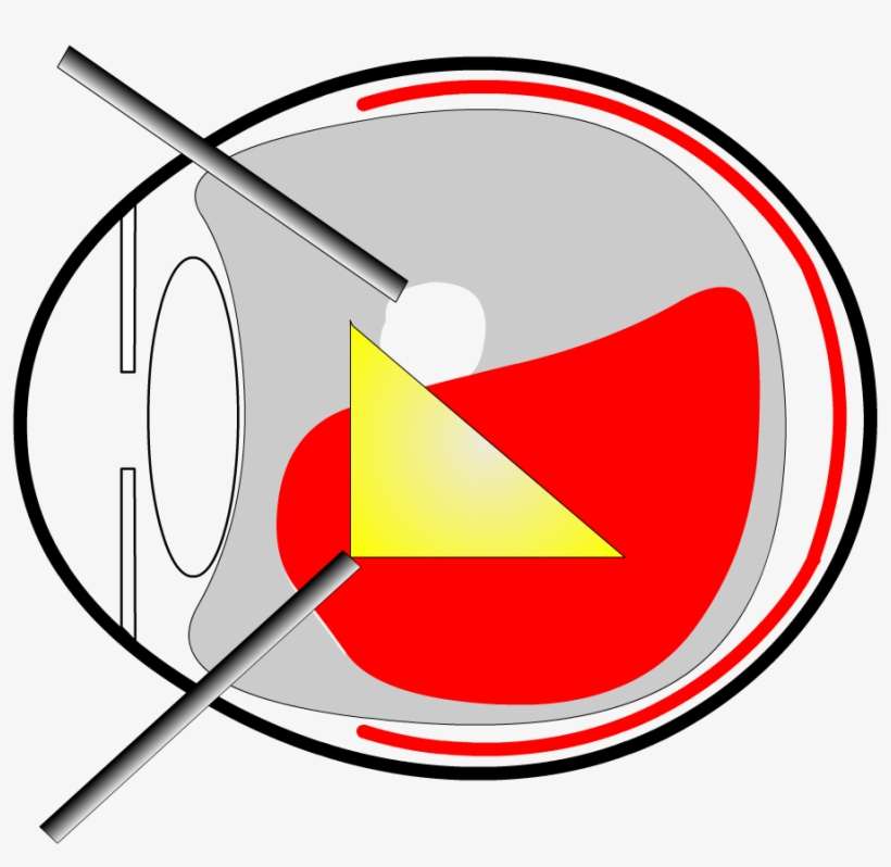 Enlarge Vitrectomy Surgery - Circle, transparent png download