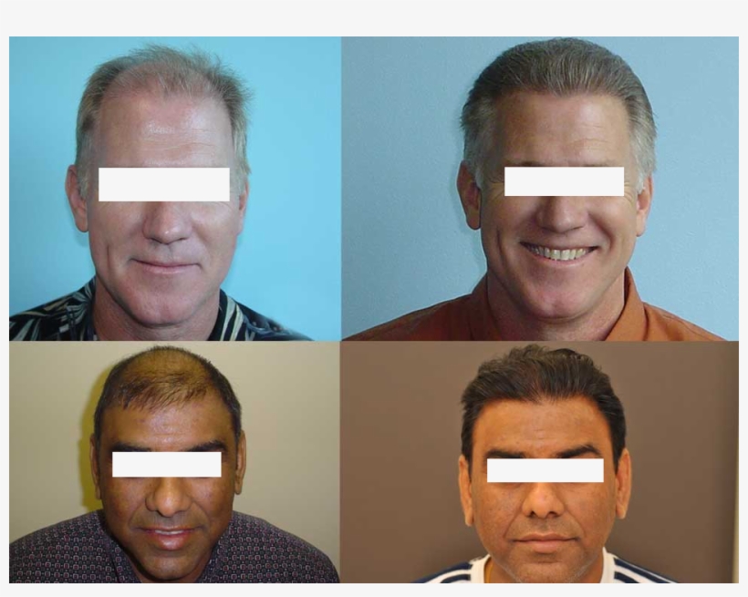 Hair Replacement Nagpur - Gentleman, transparent png download