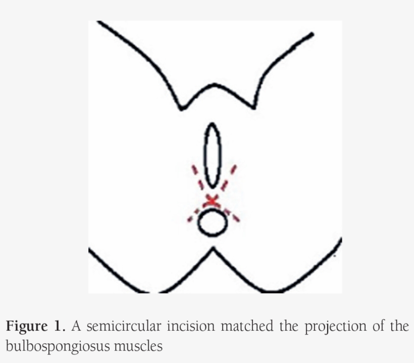 The Vaginal Mucosa Was Dissected To A Depth Of 6 Cm, - Circle, transparent png download