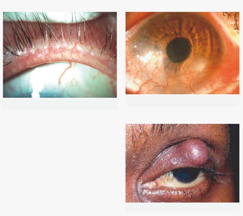 Ocular Surface Disease - Close-up, transparent png download