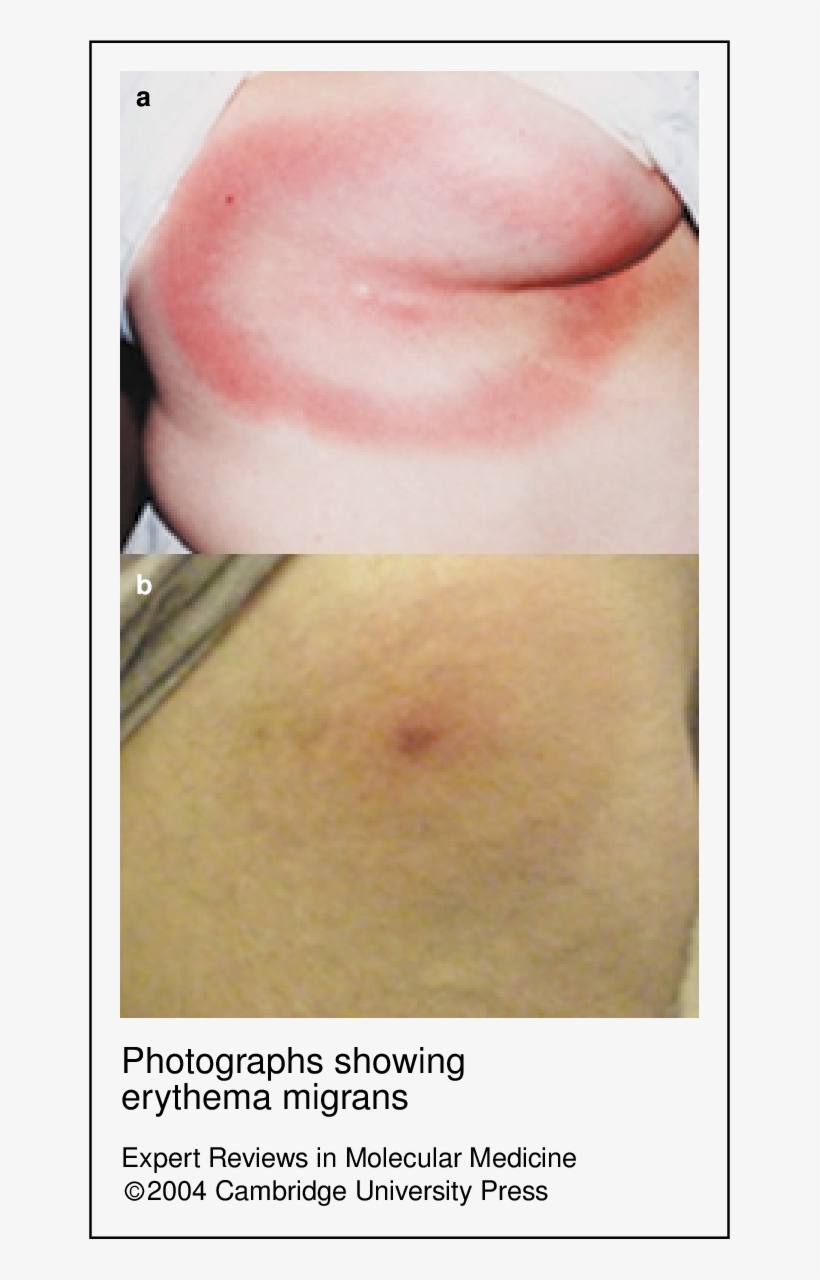 Photographs Showing Erythema Migrans - Erythema Migrans, transparent png download